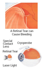 detached retina surgery recovery film on eye