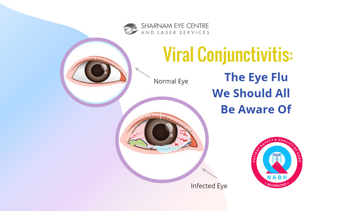 Viral Conjunctivitis treatment in Gahziabad