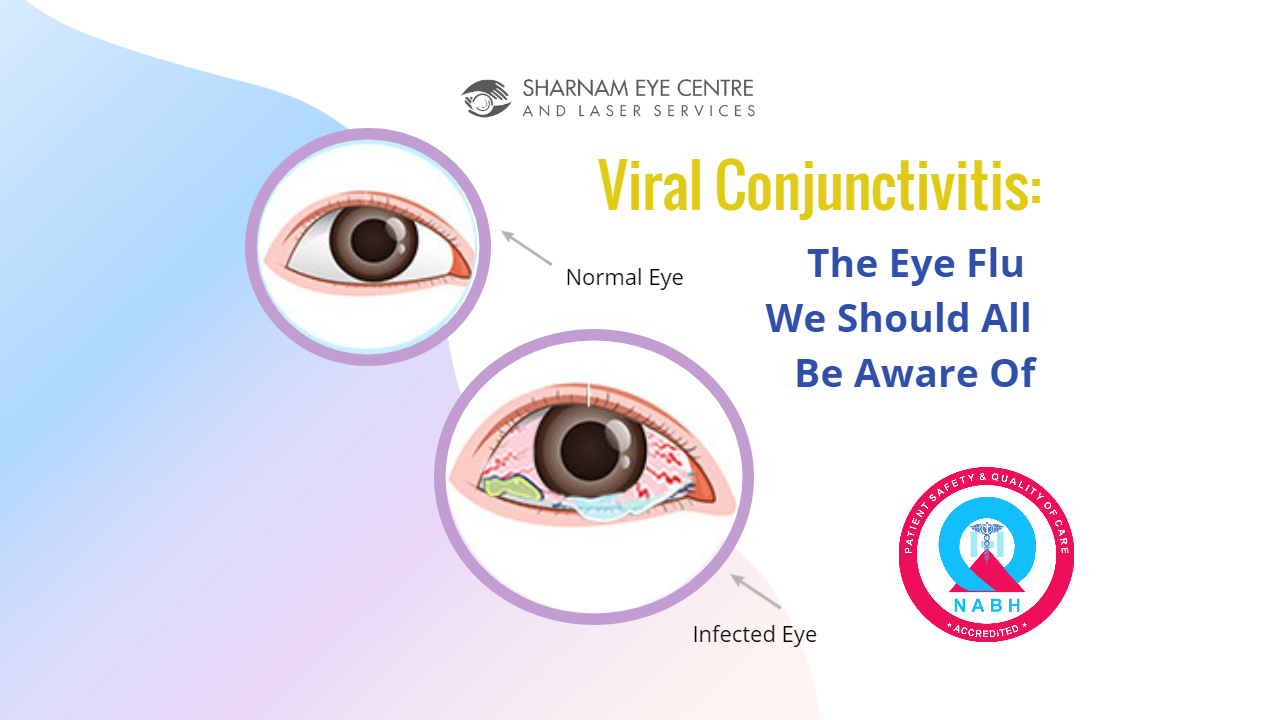 Viral Conjunctivitis treatment in Gahziabad